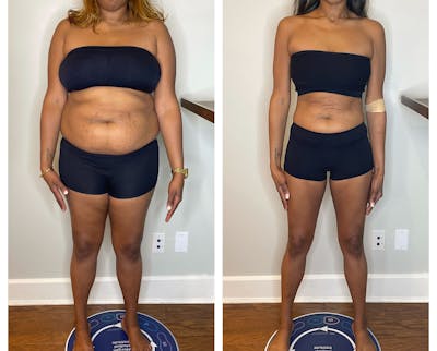 GLP-1 - Weight Loss Before & After Gallery - Patient 432433 - Image 1