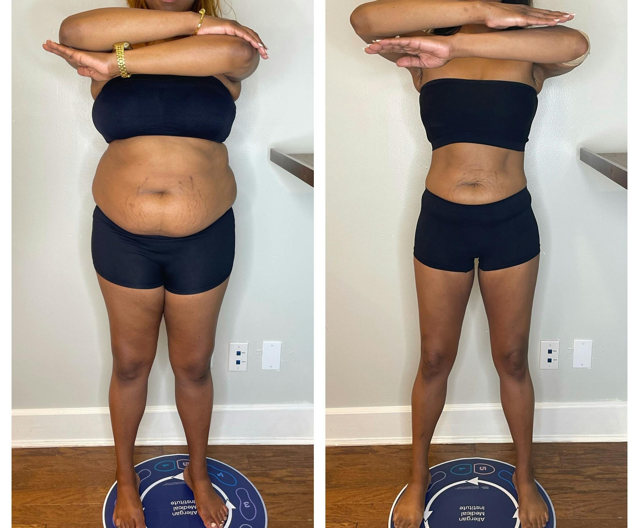 GLP-1 - Weight Loss Before & After Gallery - Patient 432433 - Image 2
