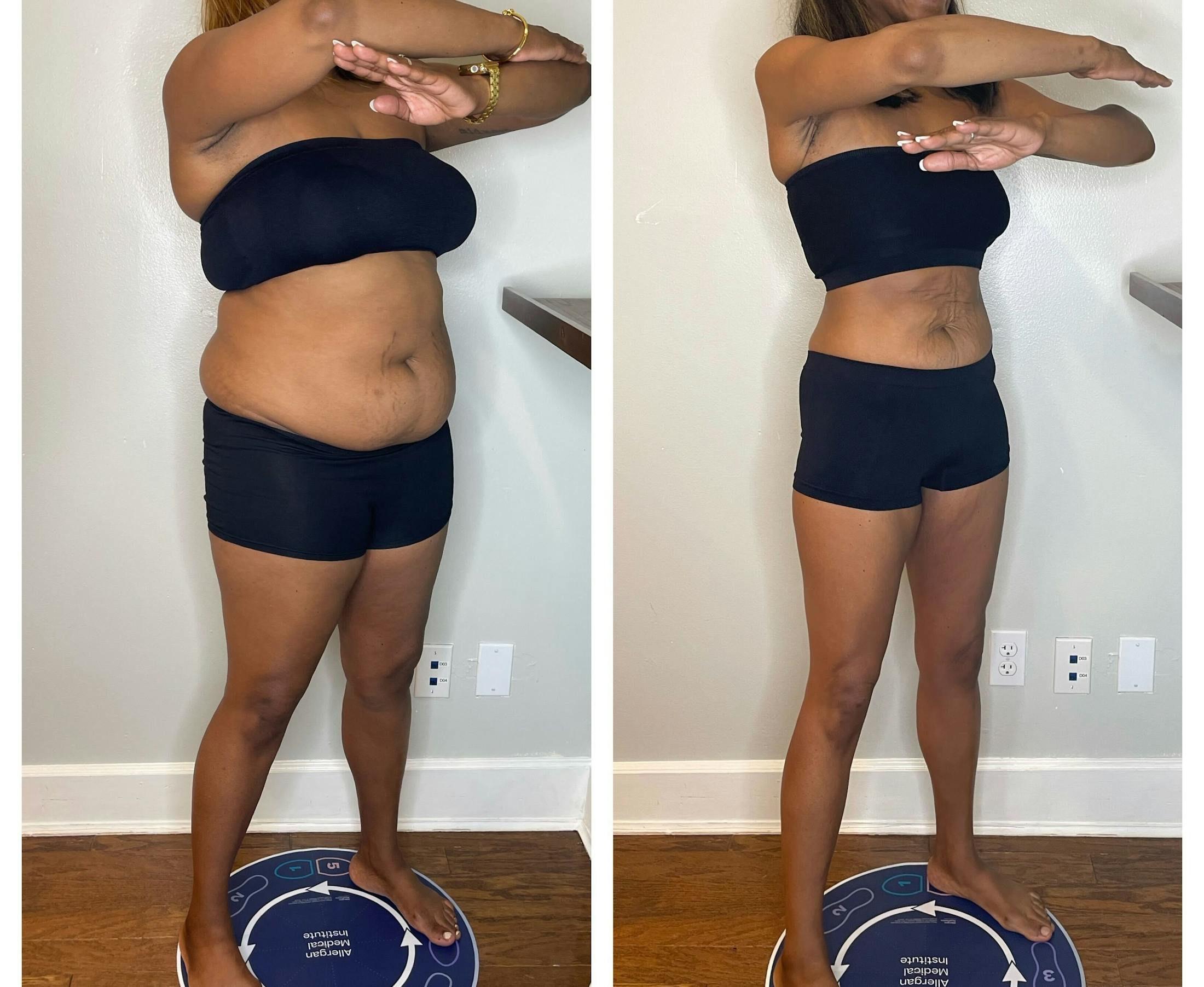 GLP-1 - Weight Loss Before & After Gallery - Patient 432433 - Image 3