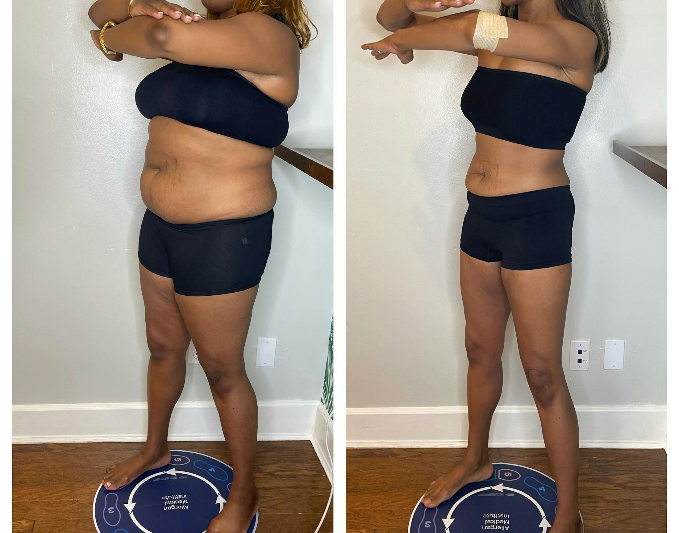 GLP-1 - Weight Loss Before & After Gallery - Patient 432433 - Image 5