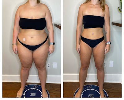 GLP-1 - Weight Loss Before & After Gallery - Patient 403443 - Image 1