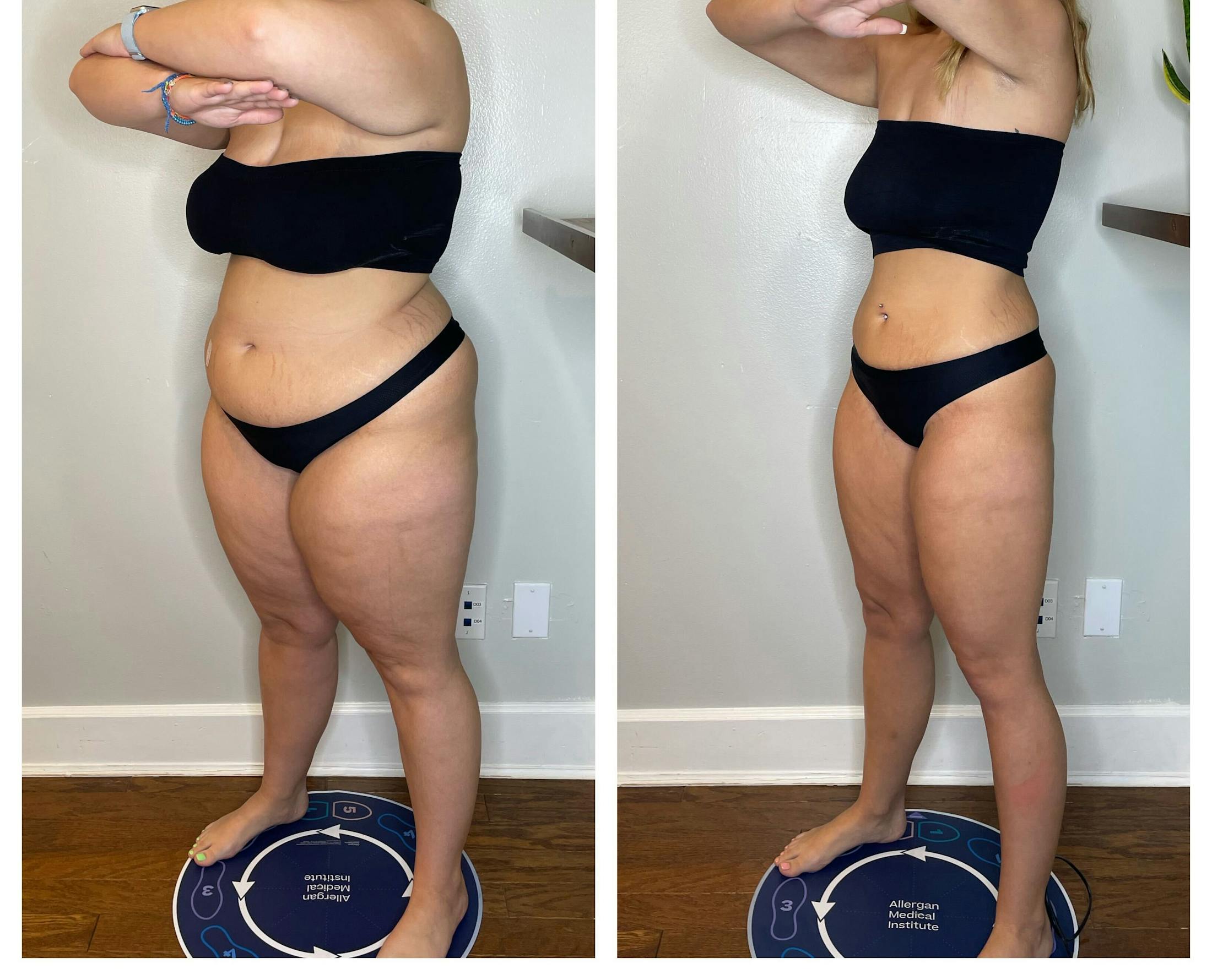 GLP-1 - Weight Loss Before & After Gallery - Patient 403443 - Image 4