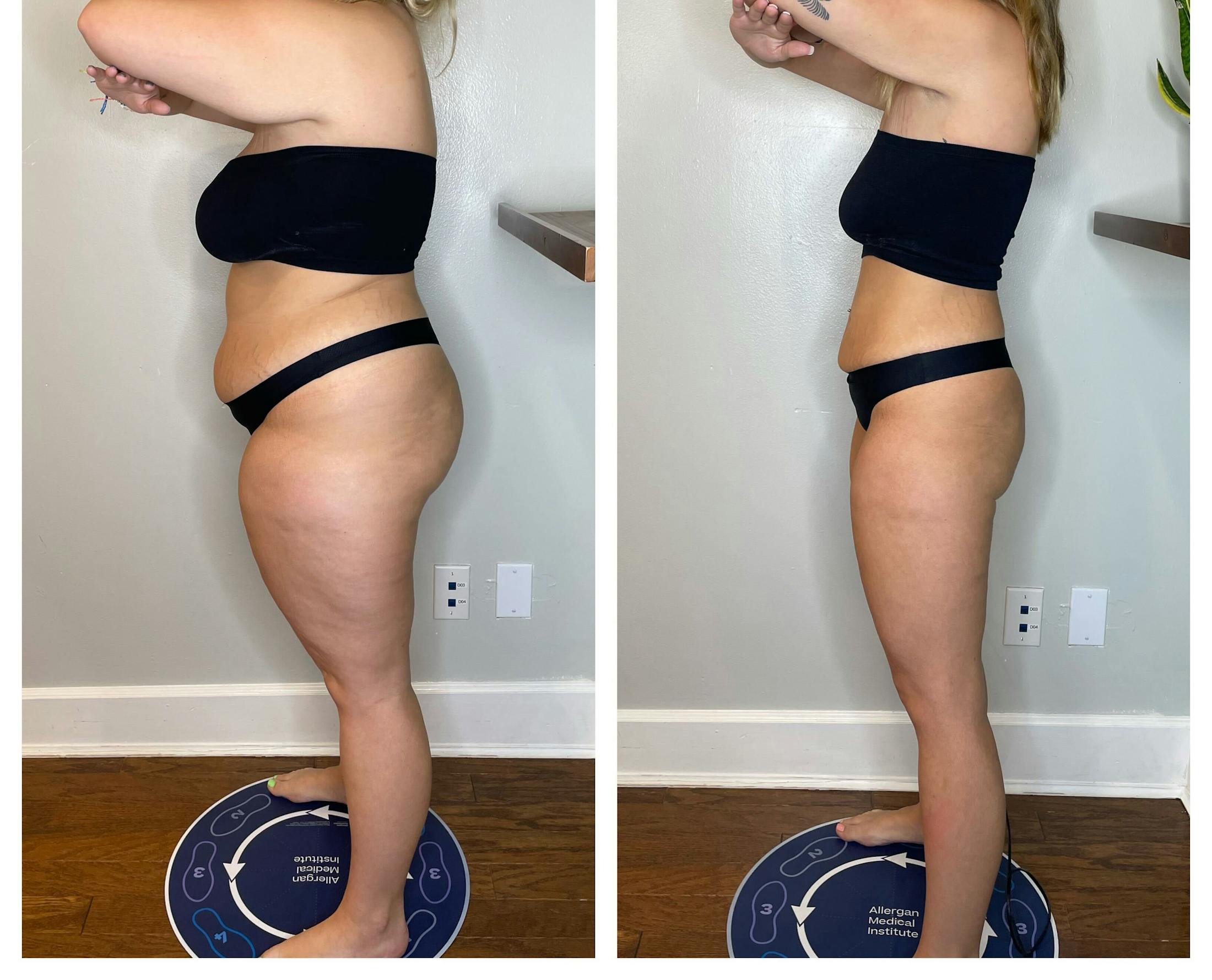 GLP-1 - Weight Loss Before & After Gallery - Patient 403443 - Image 5