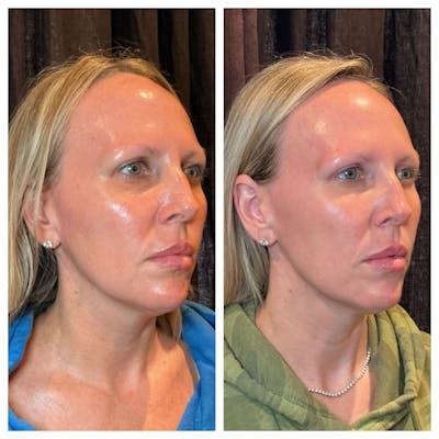 Ultherapy Before & After Gallery - Patient 264599 - Image 1