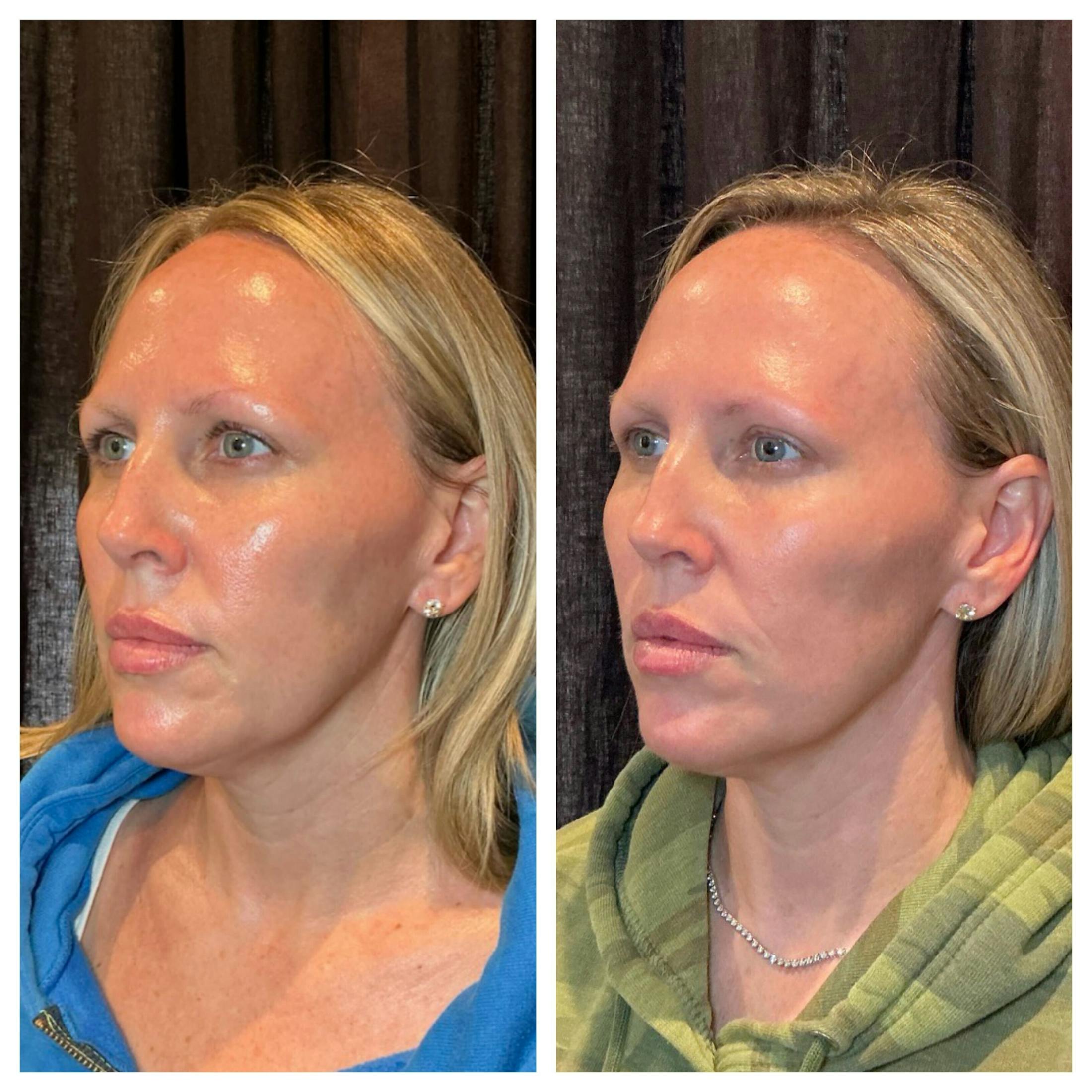 Ultherapy Before & After Gallery - Patient 264599 - Image 2