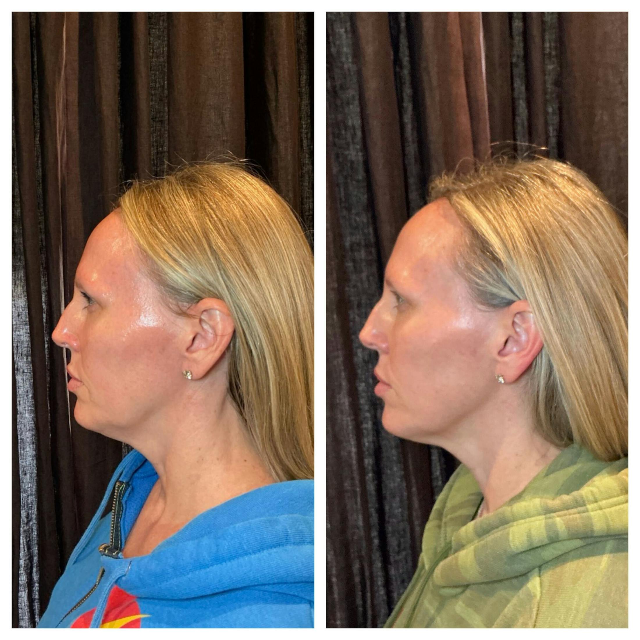 Ultherapy Before & After Gallery - Patient 264599 - Image 3