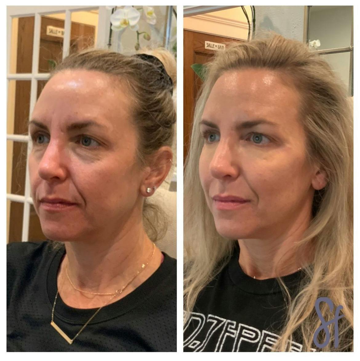 Tear Troughs Before & After Gallery - Patient 448600 - Image 1