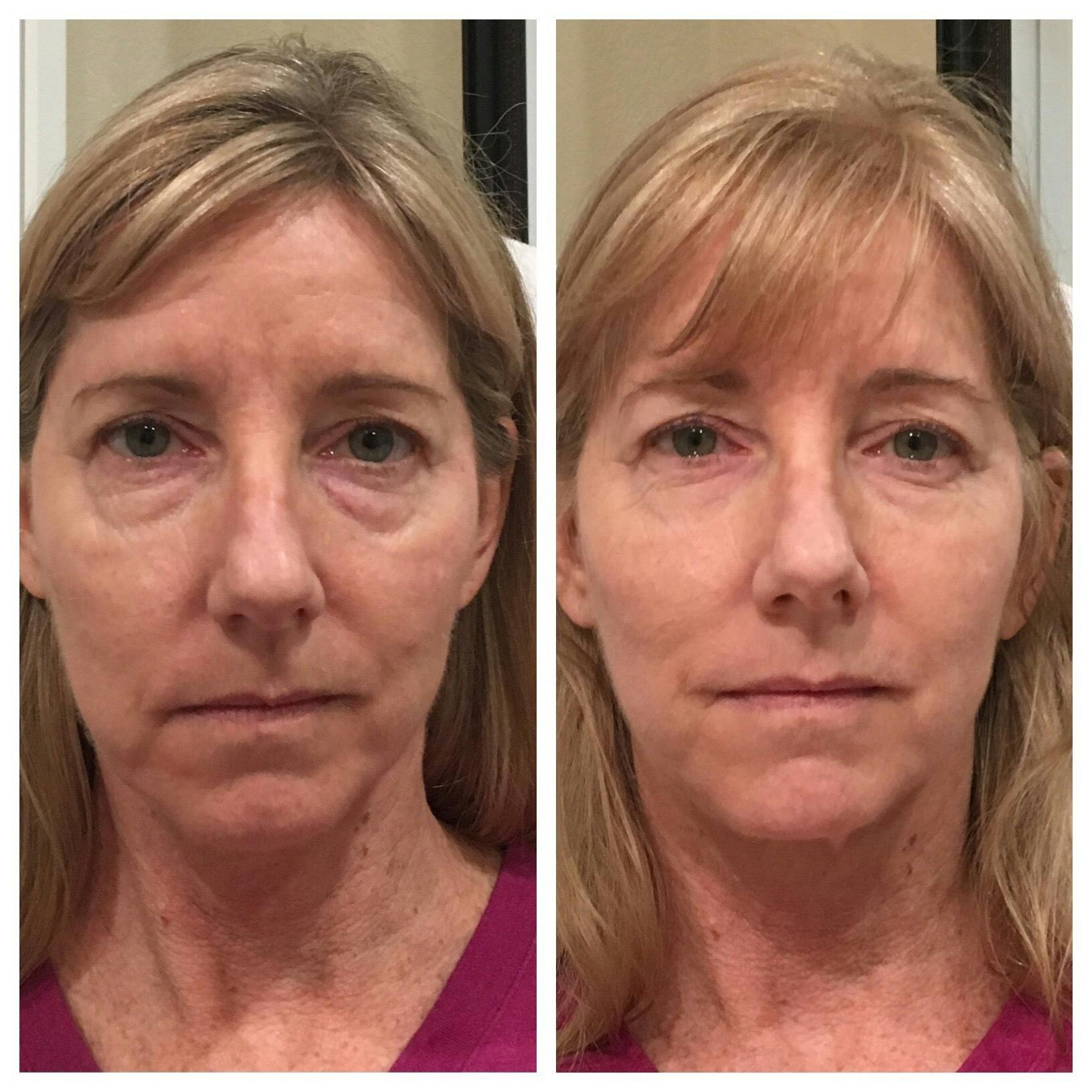 Tear Troughs Before & After Gallery - Patient 422784 - Image 1