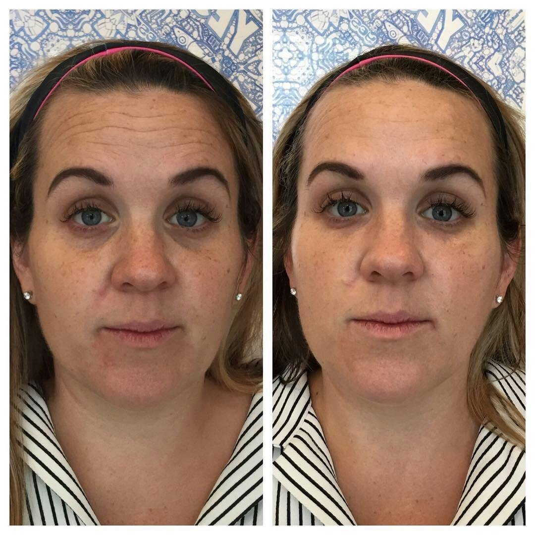 Tear Troughs Before & After Gallery - Patient 269950 - Image 1