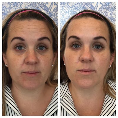 Tear Troughs Before & After Gallery - Patient 269950 - Image 1