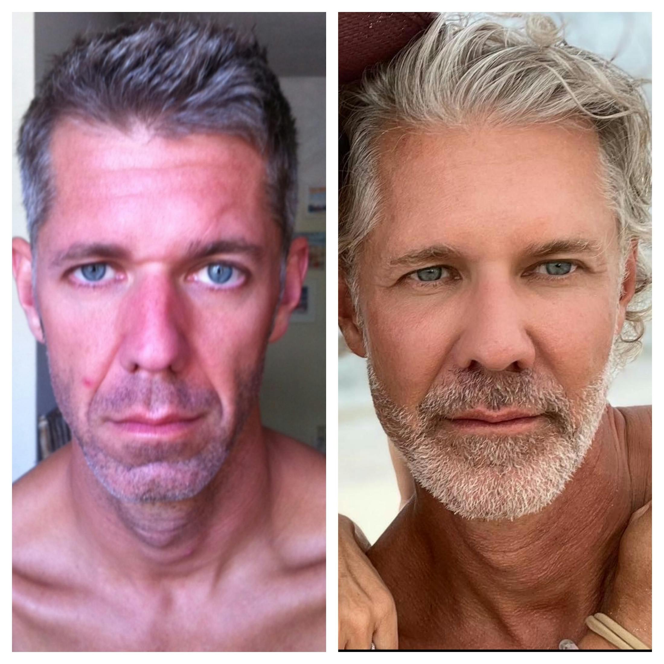 Saving Face Filter Before & After Gallery - Patient 365971 - Image 1