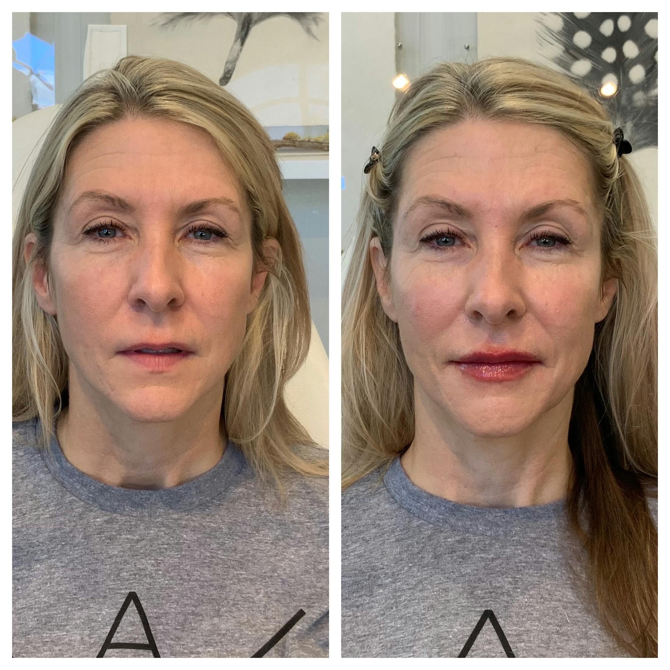 Saving Face Filter Before & After Gallery - Patient 303033 - Image 1