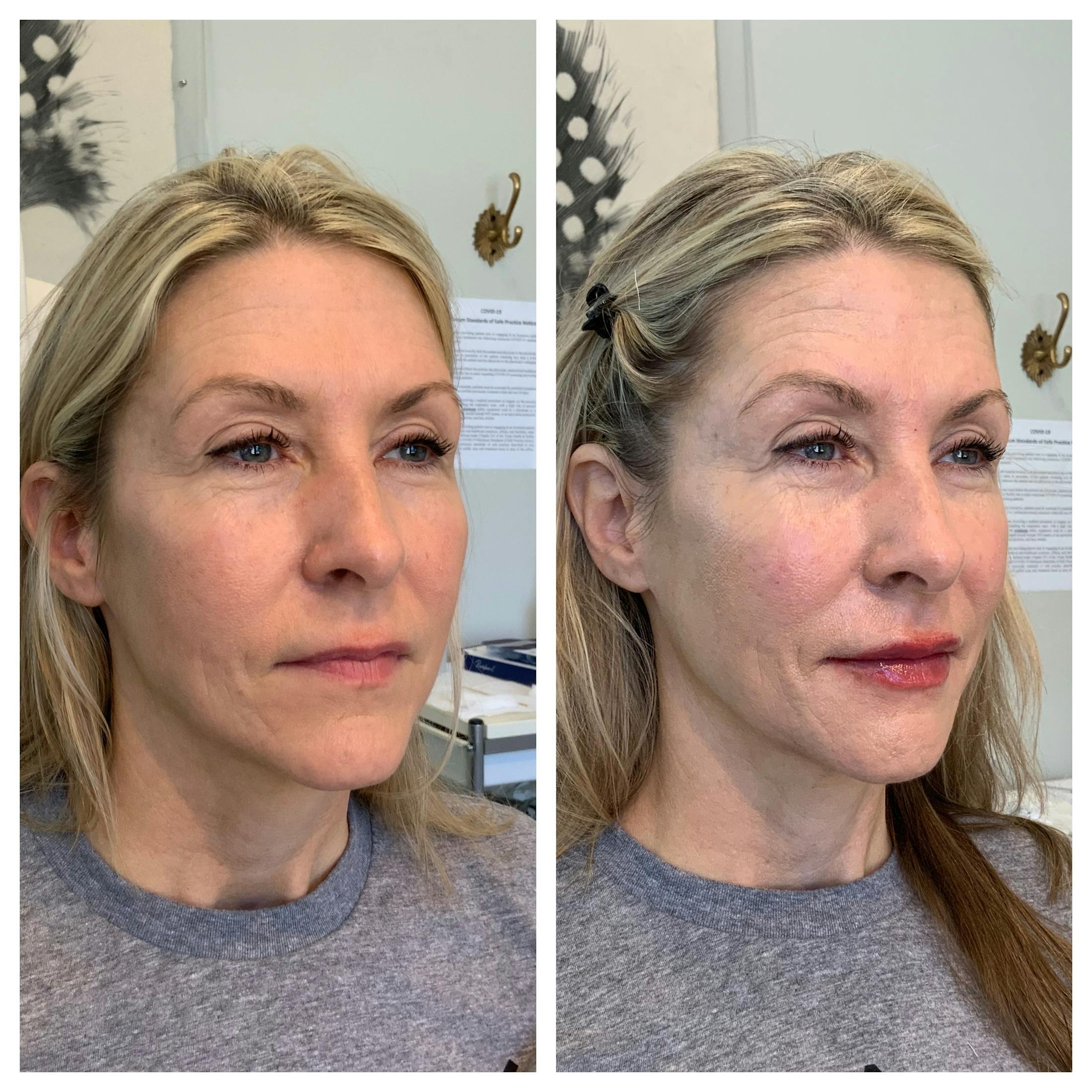 Saving Face Filter Before & After Gallery - Patient 303033 - Image 3
