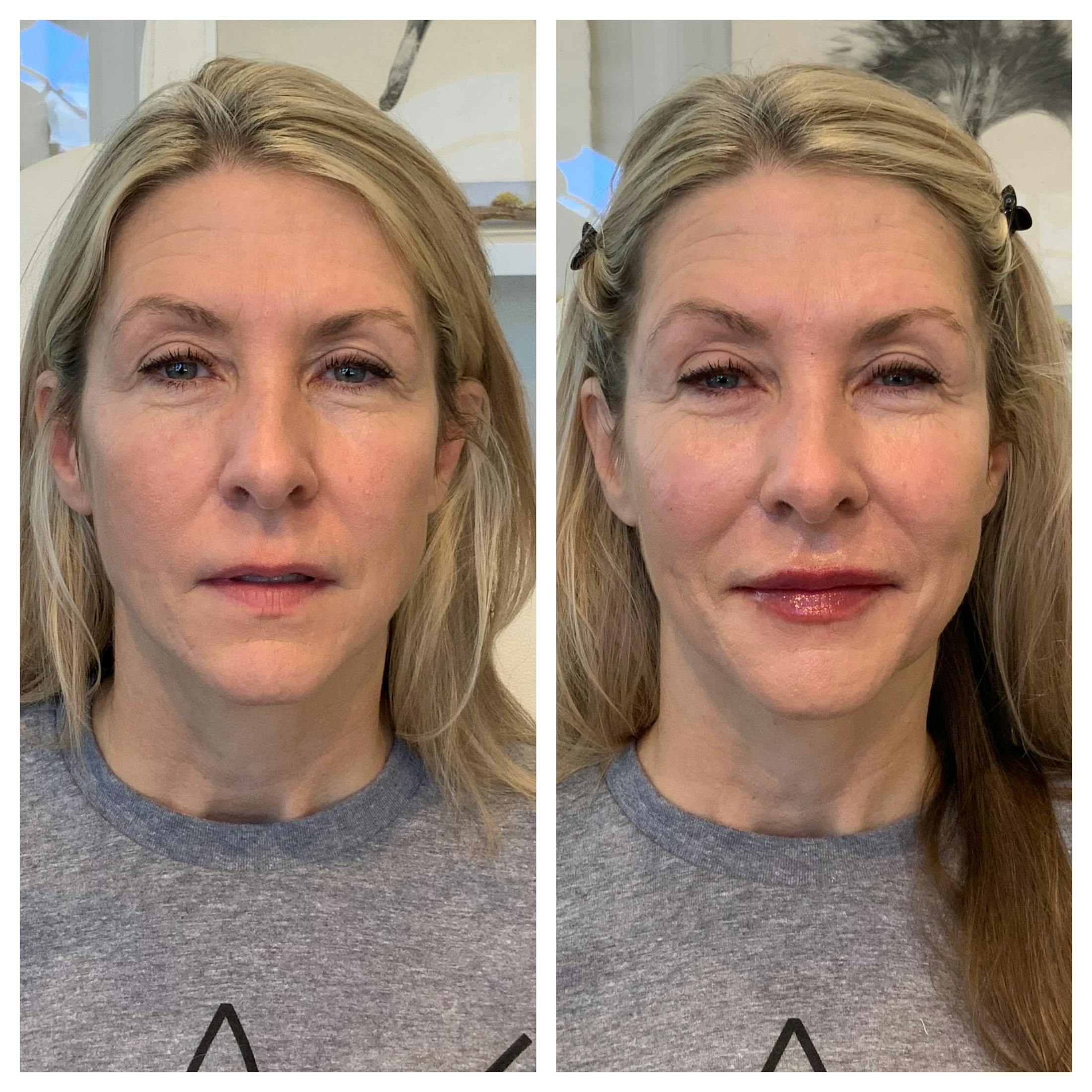 Saving Face Filter Before & After Gallery - Patient 303033 - Image 2