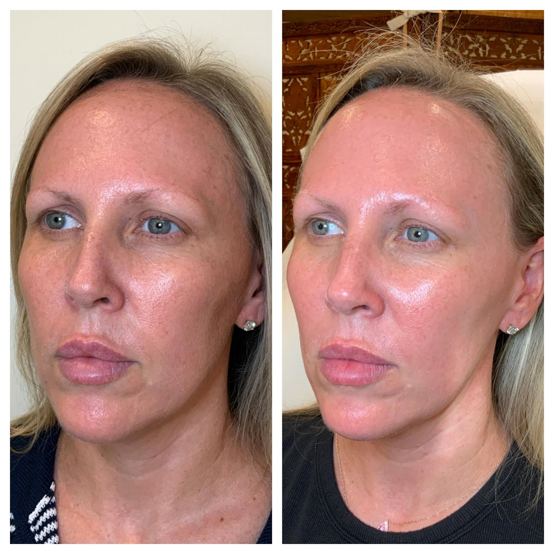 SkinPen Before & After Gallery - Patient 884332 - Image 3