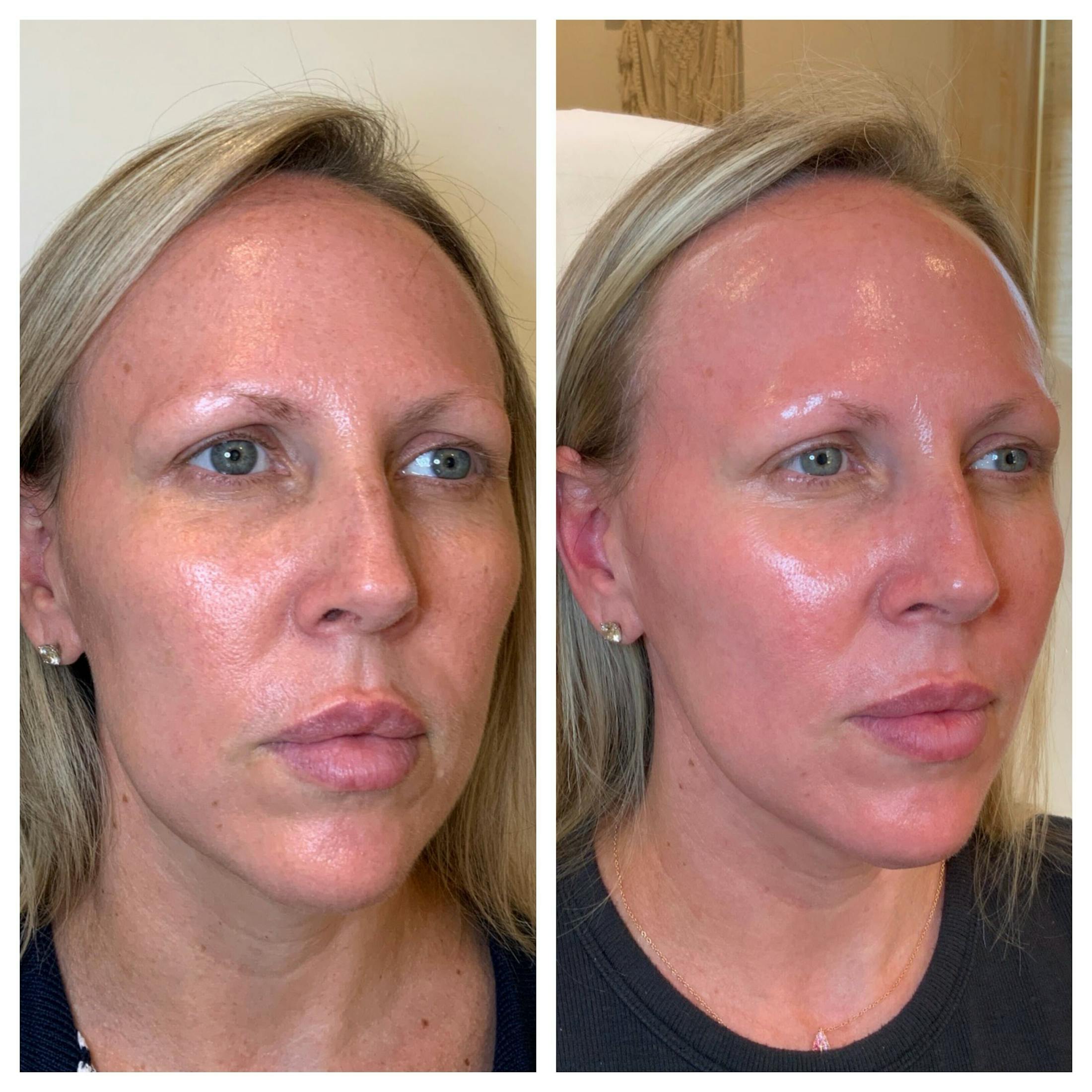 SkinPen Before & After Gallery - Patient 884332 - Image 2