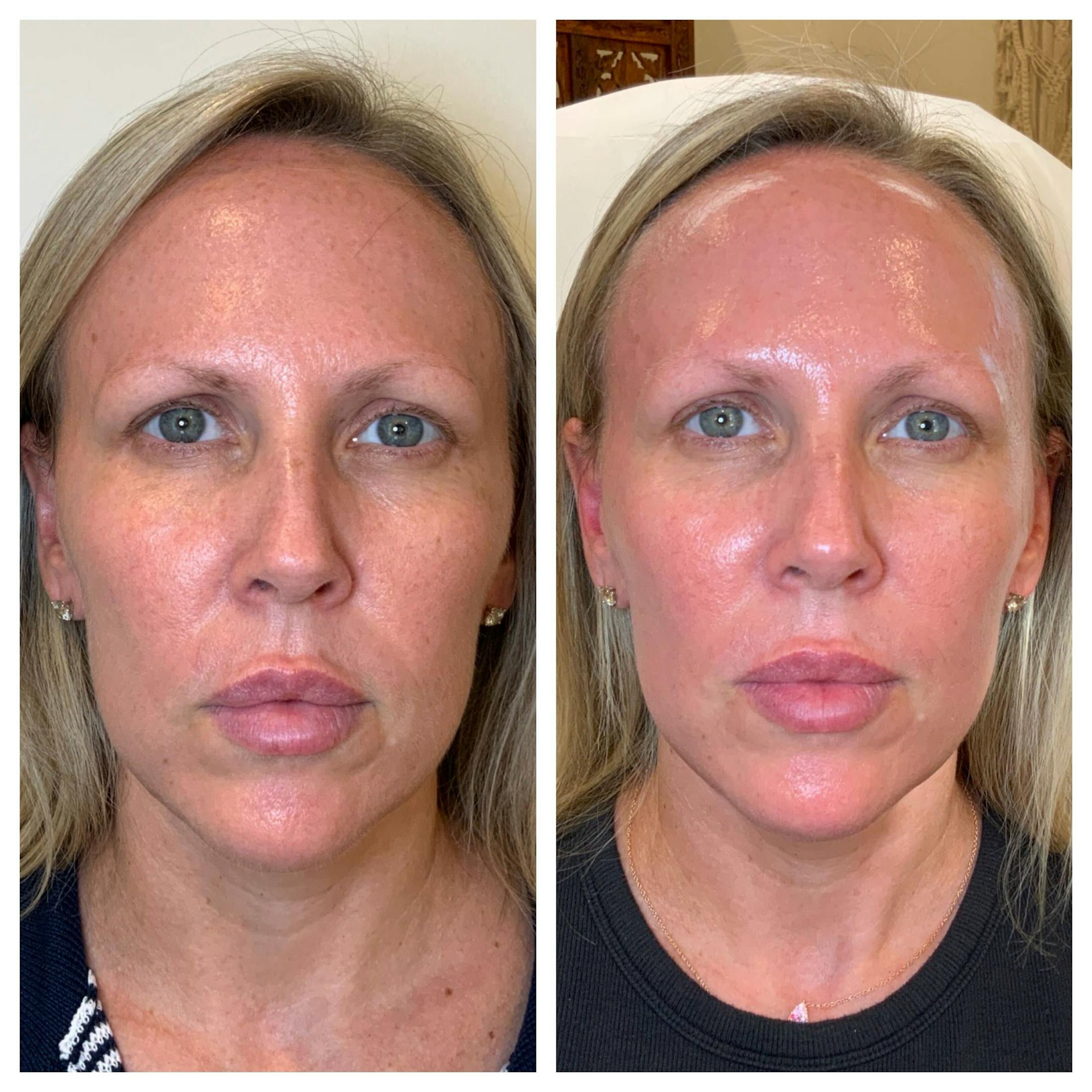 SkinPen Before & After Gallery - Patient 884332 - Image 1