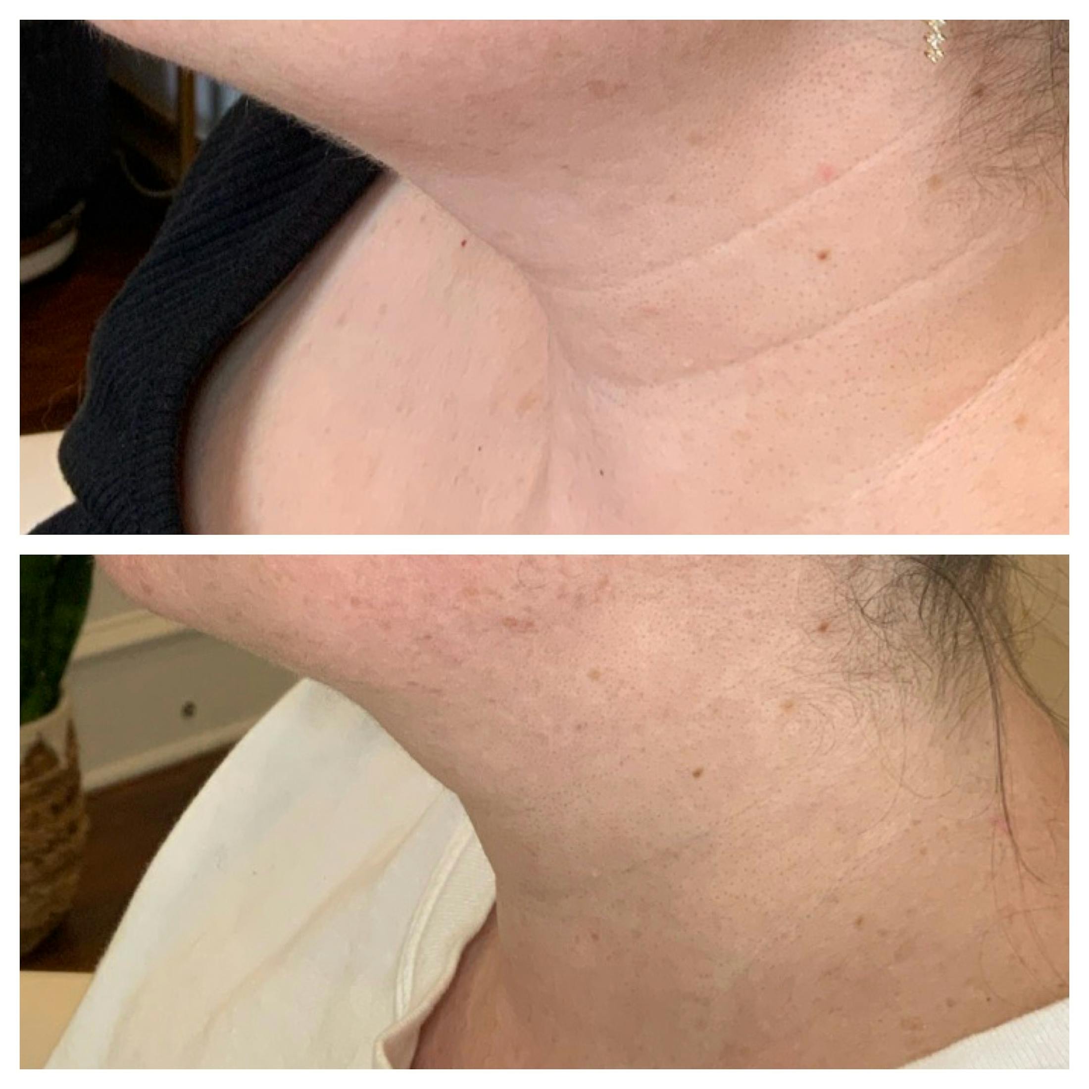 SkinPen Before & After Gallery - Patient 167325 - Image 1