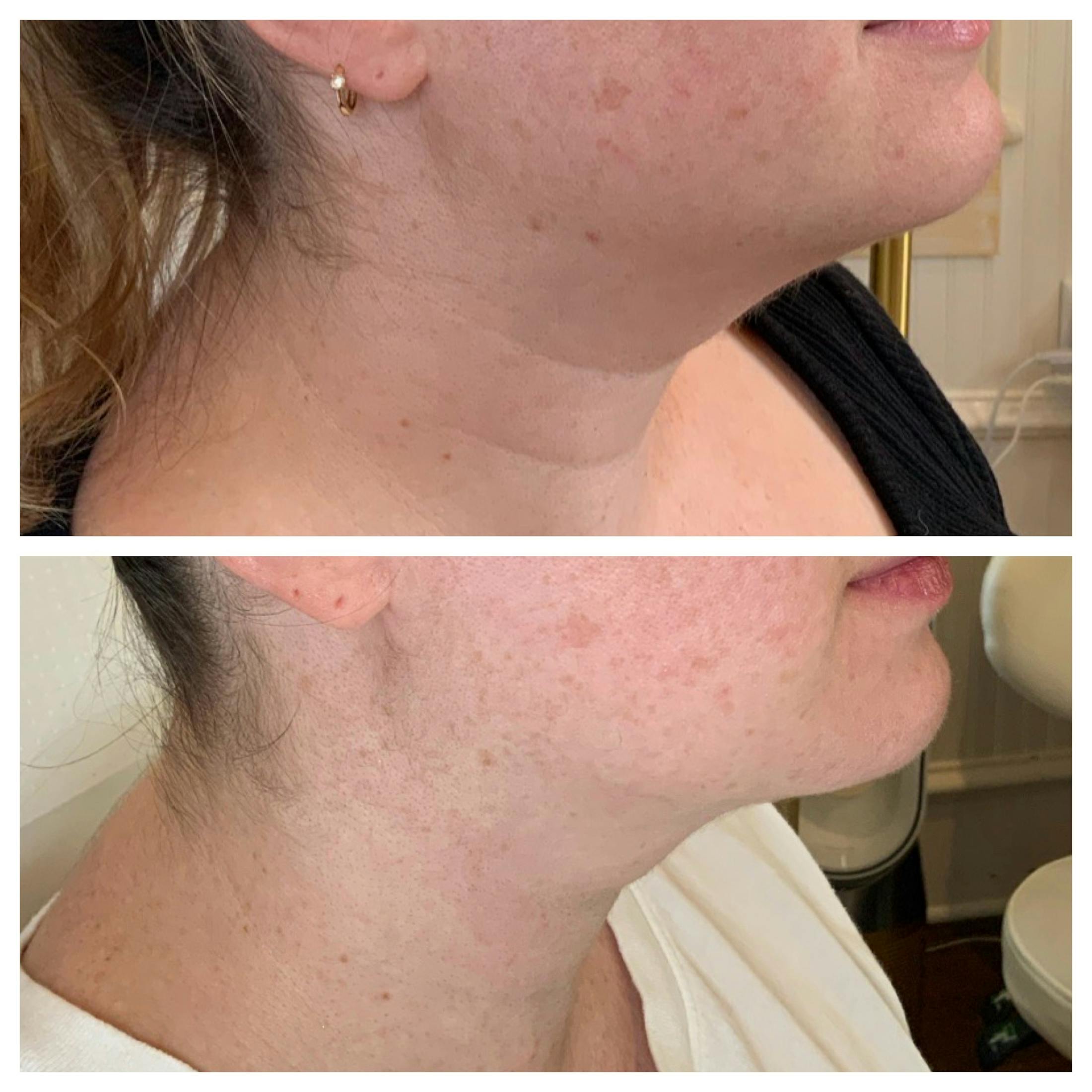 SkinPen Before & After Gallery - Patient 167325 - Image 2