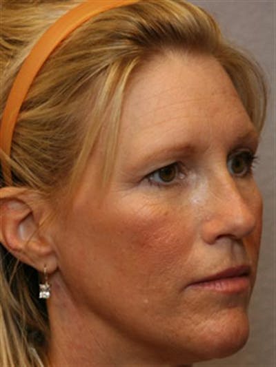 Brow Lift Before & After Gallery - Patient 1309938 - Image 1