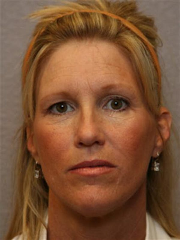 Brow Lift Before & After Gallery - Patient 1309938 - Image 3