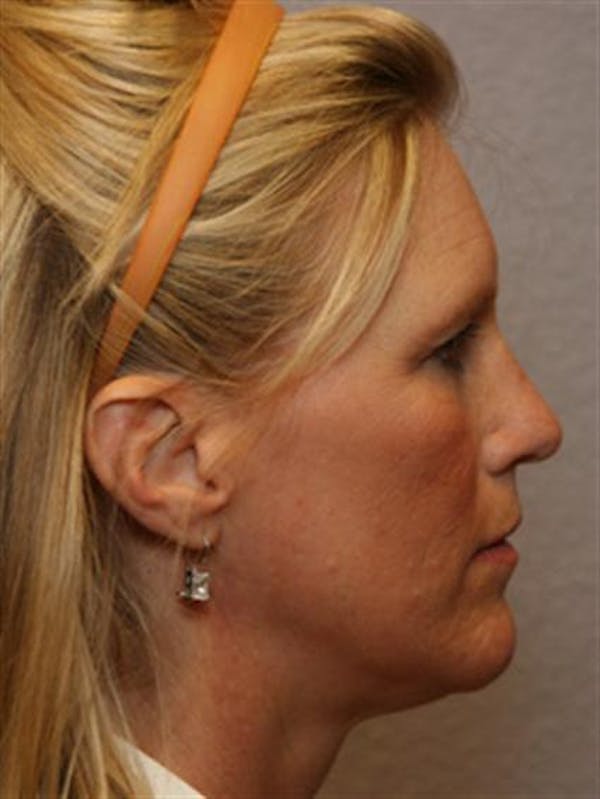 Brow Lift Before & After Gallery - Patient 1309938 - Image 5