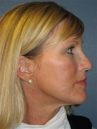 Brow Lift Before & After Gallery - Patient 1309938 - Image 6