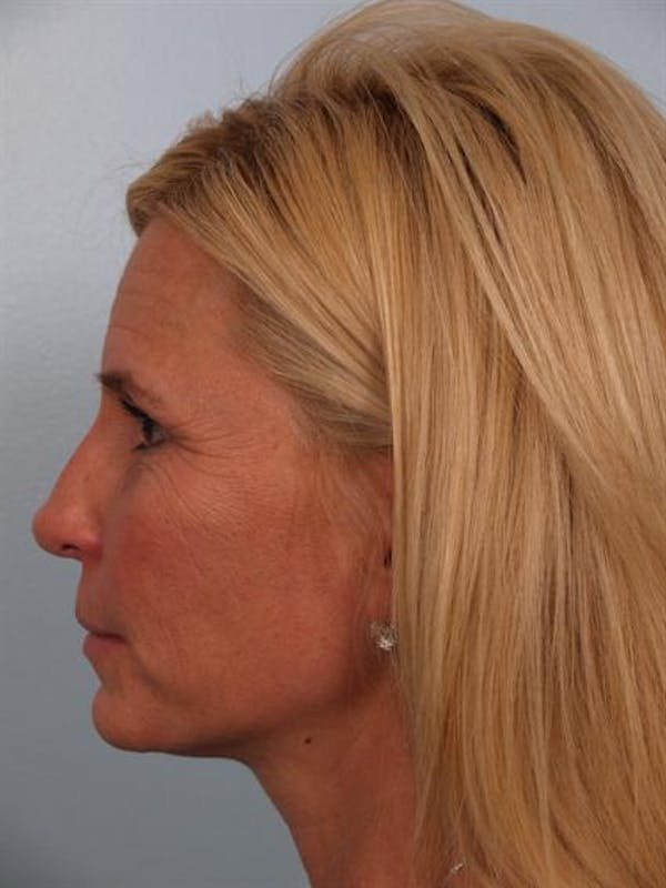 Brow Lift Gallery - Patient 1309939 - Image 5