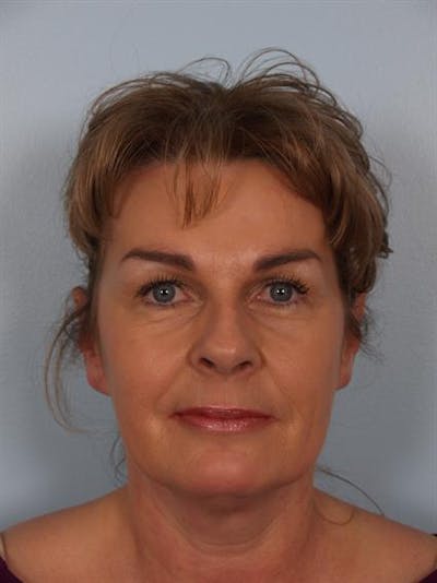 Brow Lift Before & After Gallery - Patient 1309942 - Image 2