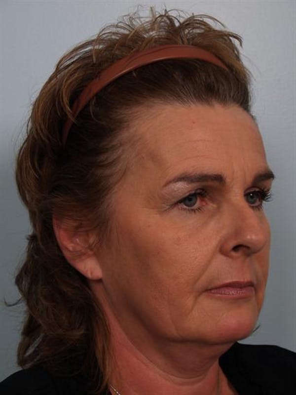 Brow Lift Before & After Gallery - Patient 1309942 - Image 3
