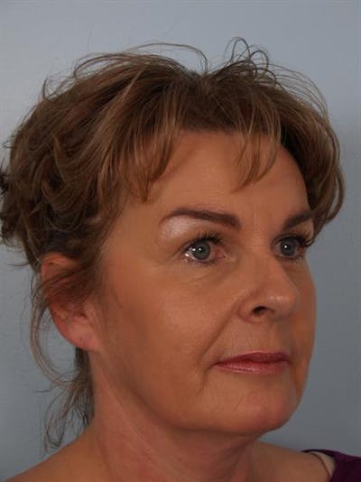 Brow Lift Before & After Gallery - Patient 1309942 - Image 4