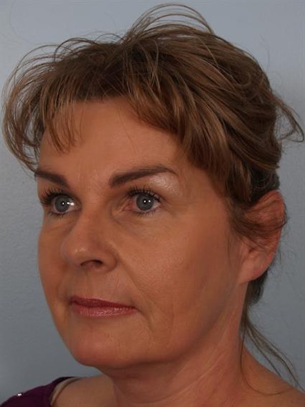 Brow Lift Before & After Gallery - Patient 1309942 - Image 6