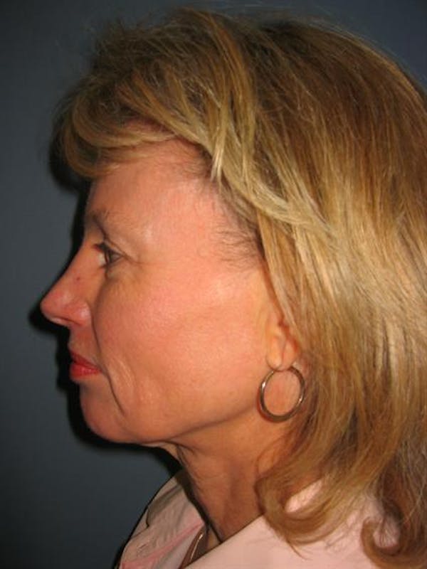 Facelift/Necklift Before & After Gallery - Patient 1309946 - Image 1