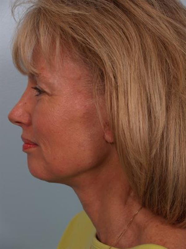 Facelift/Necklift Before & After Gallery - Patient 1309946 - Image 2