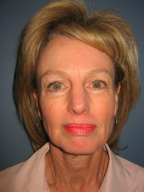 Facelift/Necklift Before & After Gallery - Patient 1309946 - Image 3