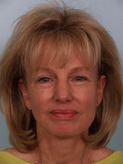 Facelift/Necklift Before & After Gallery - Patient 1309946 - Image 4