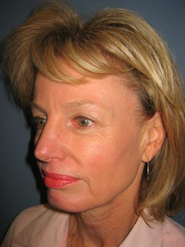 Facelift/Necklift Before & After Gallery - Patient 1309946 - Image 5