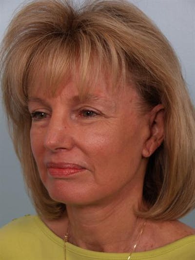 Facelift/Necklift Before & After Gallery - Patient 1309946 - Image 6