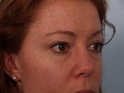 Eyelid Surgery Before & After Gallery - Patient 1309981 - Image 1