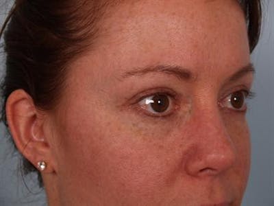 Eyelid Surgery Before & After Gallery - Patient 1309981 - Image 2