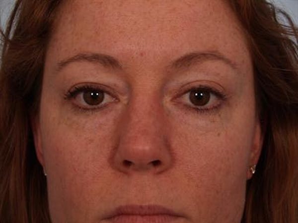 Eyelid Surgery Before & After Gallery - Patient 1309981 - Image 3