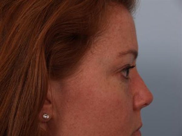 Eyelid Surgery Before & After Gallery - Patient 1309981 - Image 5