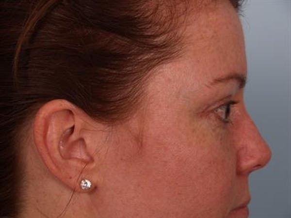 Eyelid Surgery Before & After Gallery - Patient 1309981 - Image 6