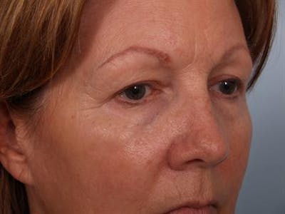 Eyelid Surgery Before & After Gallery - Patient 1309983 - Image 1