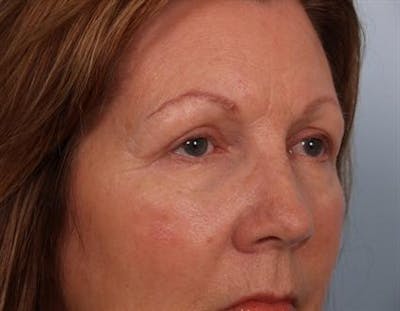 Eyelid Surgery Before & After Gallery - Patient 1309983 - Image 2