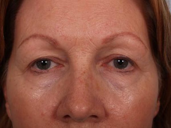 Eyelid Surgery Before & After Gallery - Patient 1309983 - Image 3
