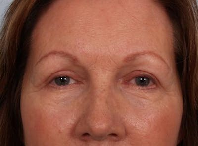 Eyelid Surgery Gallery - Patient 1309983 - Image 4