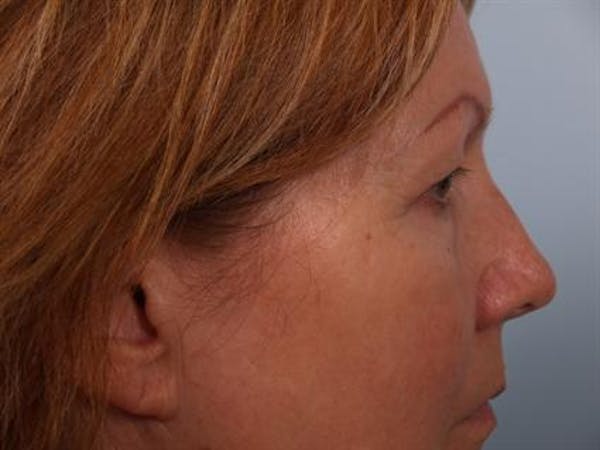 Eyelid Surgery Before & After Gallery - Patient 1309983 - Image 5