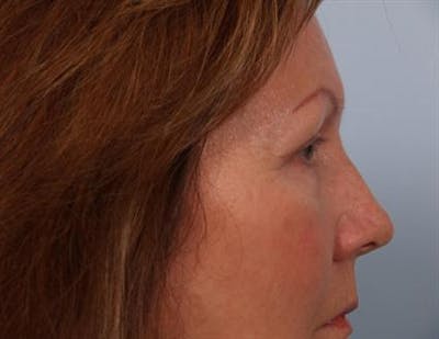 Eyelid Surgery Before & After Gallery - Patient 1309983 - Image 6