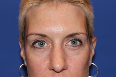 Eyelid Surgery Before & After Gallery - Patient 1309987 - Image 1